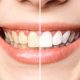 Blanqueamiento dental en Getxo