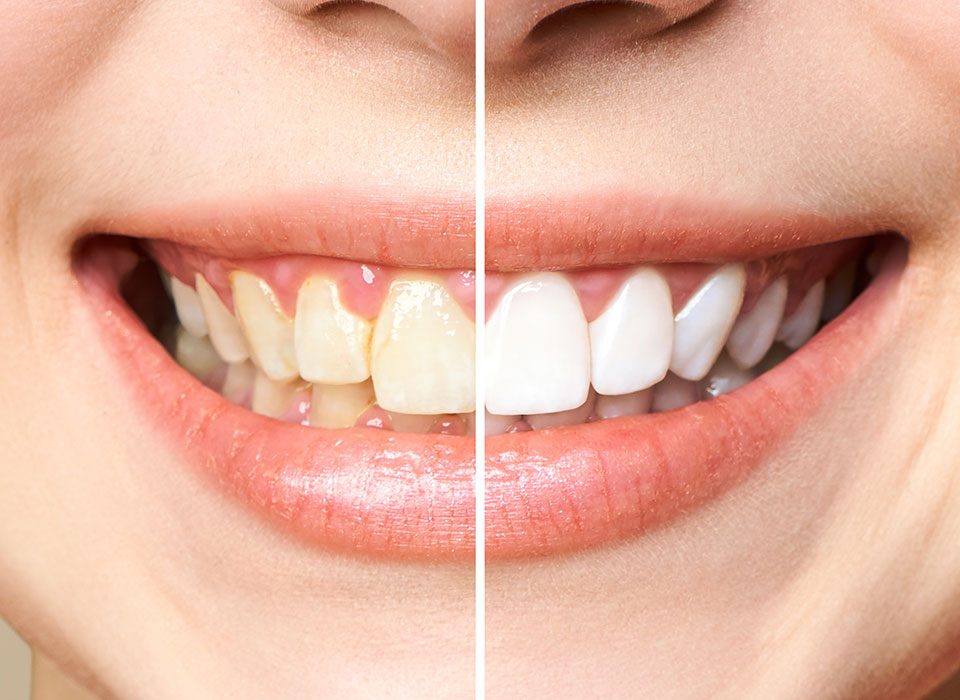 Blanqueamiento dental en Getxo