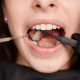 Como saber si tengo caries