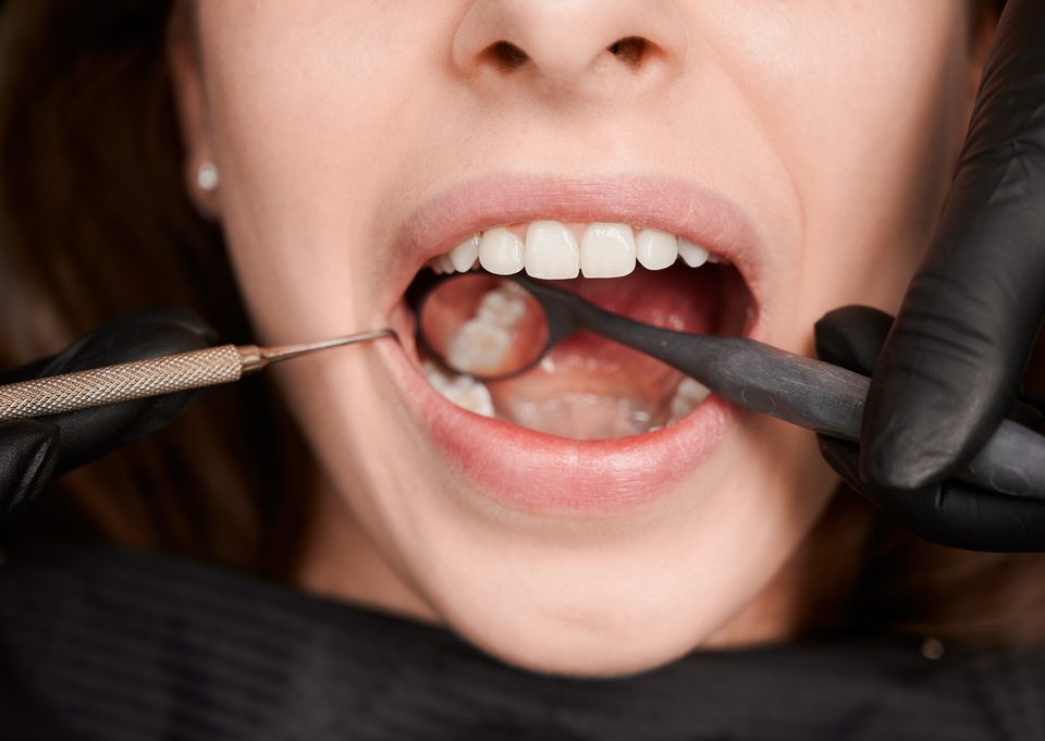 Como saber si tengo caries