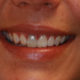 Oscurecimiento dental