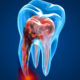 Endodoncia en Getxo