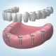 implantes dentales en Getxo