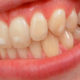 manchas blancas en los dientes