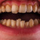 dientes oscurecidos causas y remedios
