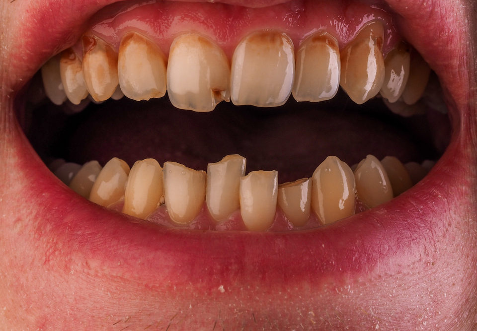 dientes oscurecidos causas y remedios