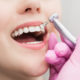 limpieza dental profesional